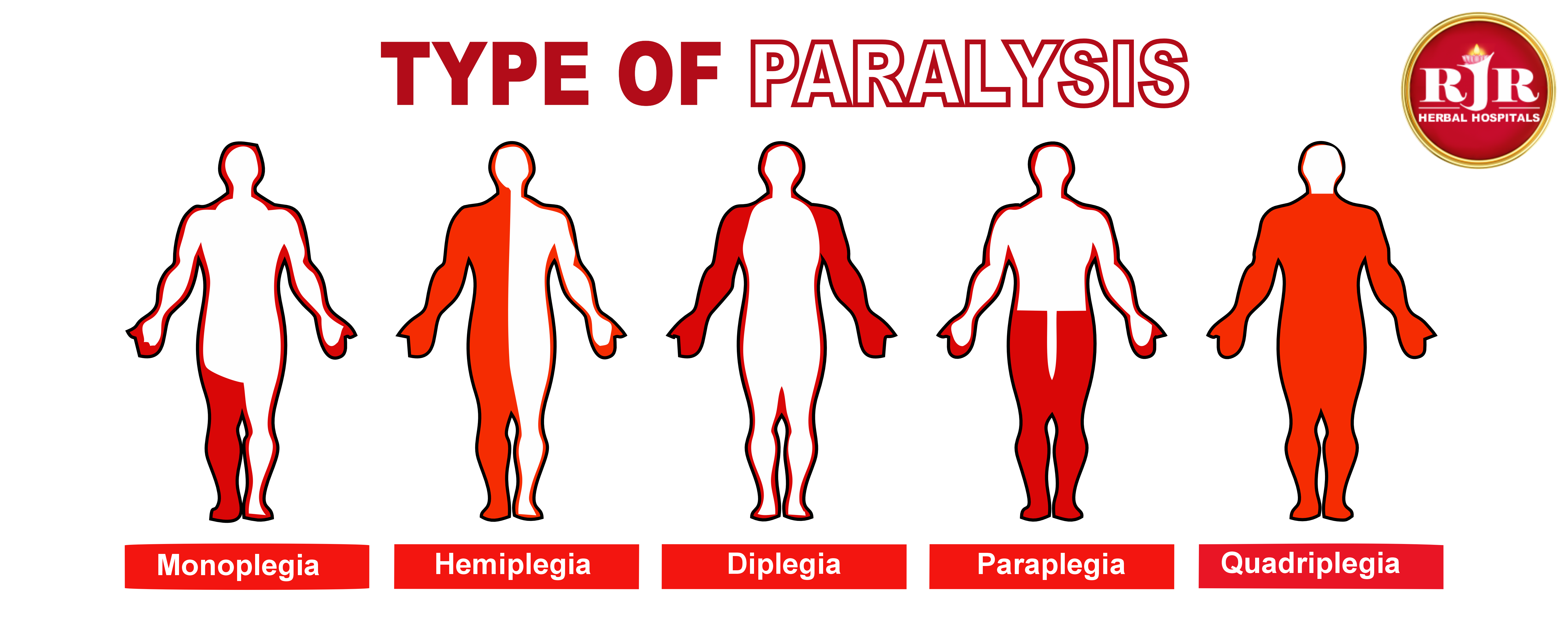 paralysis siddha treatment in chennai varmam therapy