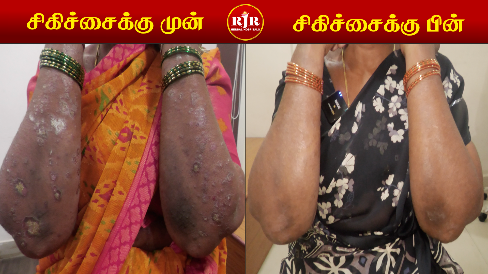 Psoriasis Before and After Treatment Chennai