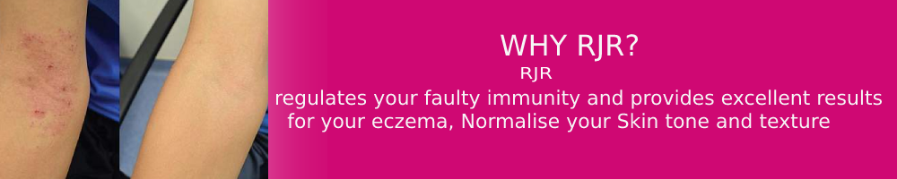 Eczema   